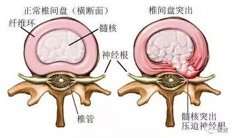 腰椎间盘突出能不能彻底治好？我们看看老中医的回答