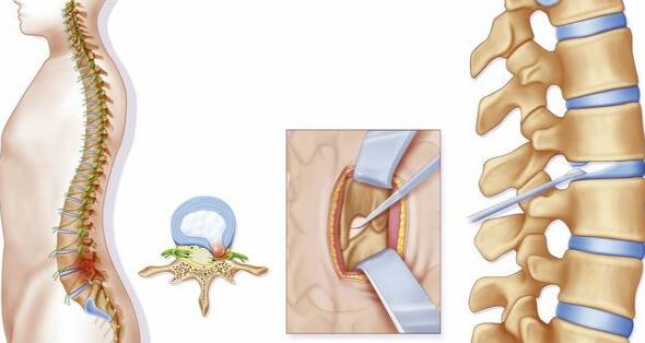 椎间盘突出到底指什么