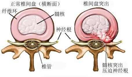 腰椎间盘突出