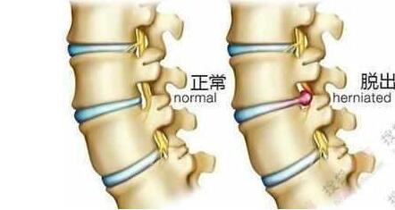 腰椎间盘突出